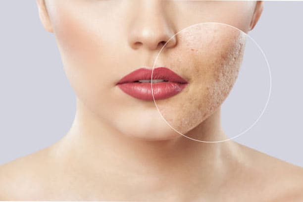 Acne Removal Treatment