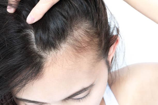 Hair thinning treatments