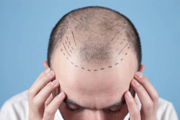 Ultra Receptive FUE Hair Transplant