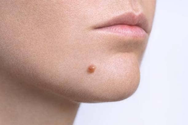 Mole & Wart removal clinic in Delhi