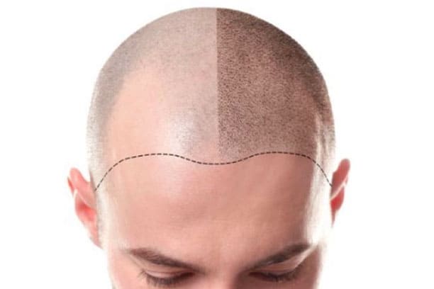 Scalp Micropigmentation