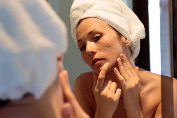 Acne removal treatment in Delhi